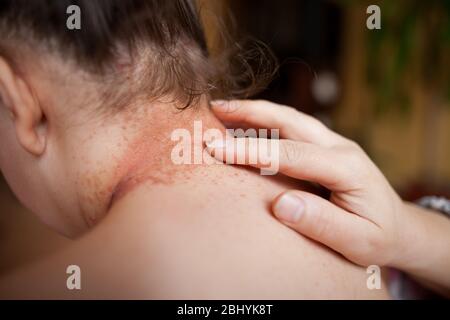 Le mani della donna lubrificano la pelle danneggiata sulla parte posteriore con unguento healing, concetto di sanità Foto Stock