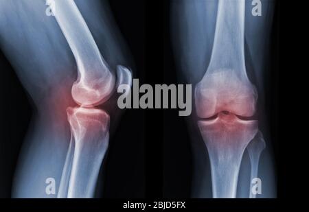 La radiografia del ginocchio a raggi X mostra lo stato di lesione Foto Stock