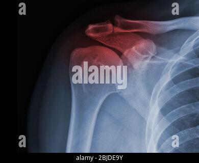 La radiografia della spalla a raggi X mostra lo stato di lesione Foto Stock