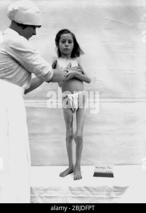 Bambini con Rickets giovane ragazza che viene curata in un sanitorium in Hampshire Inghilterra nel 1925. Trattamento della salute dei farmaci malnutrizione povera Gran Bretagna British cura la terapia della luce degli anni '30 Foto Stock