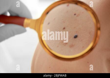 Dermatologo che guarda i segni di nascita del paziente attraverso la lente di ingrandimento, closeup Foto Stock