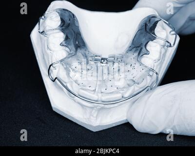 Fermo ortodontico rimovibile. Staffa o fermo rimovibile Dental Blue per denti, ortodontico in mano Foto Stock