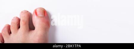 Toenail ingrown. Problema di chiodo infetto e irritato Foto Stock