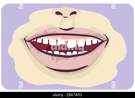Illustrazione di una bocca aperta con dente scheggiato sintomo di decadimento Foto Stock