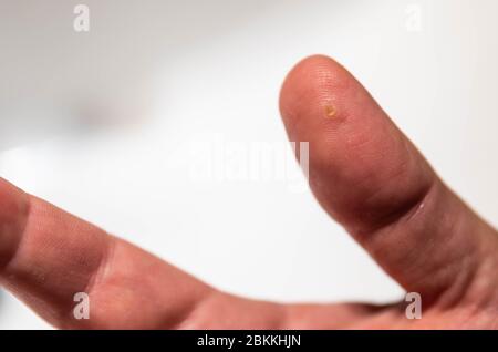 Primo piano del pollice della mano destra di un uomo caucasico che soffre di verruca. Si può notare la macchia circolare dell'area infetta. Foto Stock