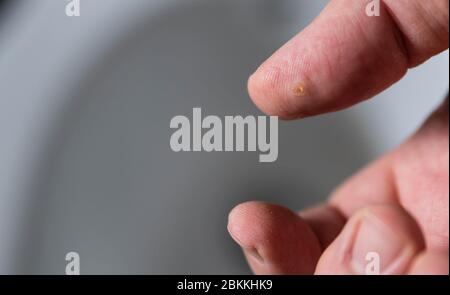 Primo piano del pollice della mano destra di un uomo caucasico che soffre di verruca. Si può notare la macchia circolare dell'area infetta. Foto Stock