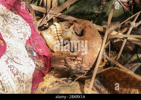 Vista ravvicinata del cranio umano di un uomo deceduto. Il cranio è ancora coperto di pelle con capelli e tessuti muscolari. Il cervello è visibile attraverso un foro nel Th Foto Stock