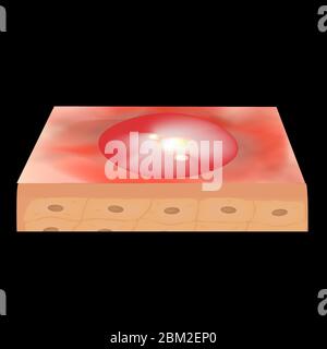 Cisti acne. Furuncle Acne sulla pelle cisti e pimples. Malattie infiammatorie dermatologiche e cosmetiche sulla pelle del viso. Infografica Illustrazione Vettoriale