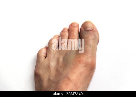 Punta grande rotta (fratturata). Foto Stock