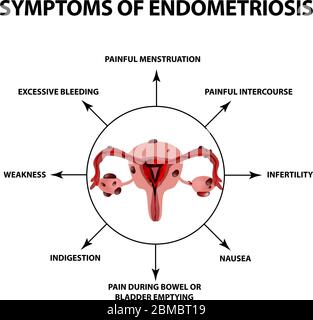 Sintomi dell'endometriosi. La struttura delle ovaie uterine. Infografica. Illustrazione vettoriale su sfondo isolato Illustrazione Vettoriale