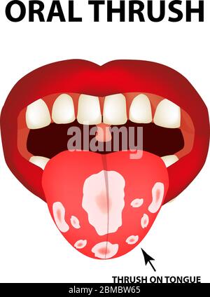 Brivido orale. Candidiasi sulla lingua. Fungo in bocca. Infografica. Illustrazione vettoriale su sfondo isolato. Illustrazione Vettoriale