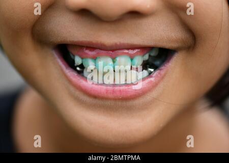 bambino cattivo dentale con corona Foto Stock