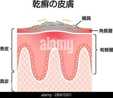 Sezione trasversale della pelle psoriasica / illustrazione del vettore piatto Illustrazione Vettoriale