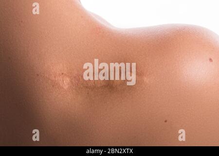 Primo piano della spalla femminile con una cicatrice Foto Stock