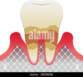 Le fasi della parodontite / periodontite moderata Illustrazione Vettoriale