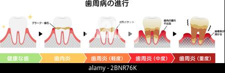 Le fasi della parodontite malattia illustrazione vettoriale Illustrazione Vettoriale