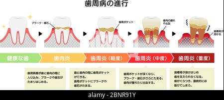 Le fasi della parodontite malattia illustrazione vettoriale Illustrazione Vettoriale
