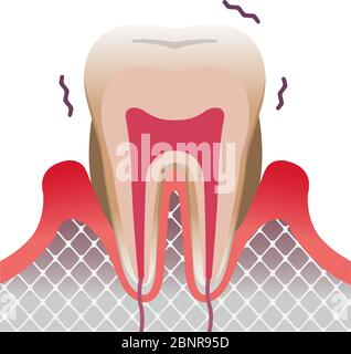 malattia parodontale illustrazione vettoriale piatta dei denti e delle gengive Illustrazione Vettoriale