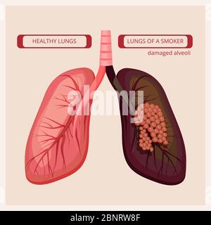 Polmoni fumanti. Fumo danni umani cancro polmonare vettore infografica medica Illustrazione Vettoriale