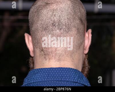 Vista posteriore di un uomo calvo che soffre di acne del cuoio capelluto, puntini rossi itchy sulla parte posteriore della testa Foto Stock