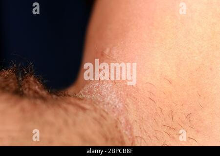 Infezione fungina nell'inguine, psoriasi, dermatite, eczema. Foto Stock