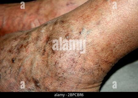 Gamba. Vene varicose. Flebeurisma. Tromboflebite.gamba nelle vene Foto Stock