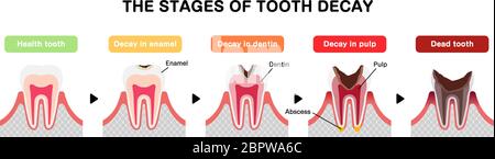 Le fasi di decadimento dei denti / illustrazione vettoriale piatta Illustrazione Vettoriale