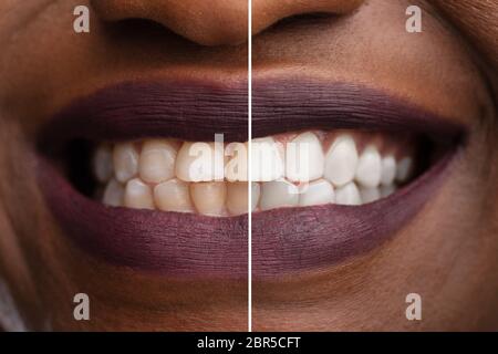 Close-up di una donna sorridente i denti prima e dopo sbiancamento Foto Stock