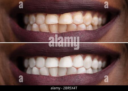 Close-up di una donna sorridente i denti prima e dopo sbiancamento Foto Stock