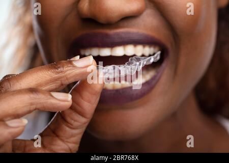 Close-up di una donna mettendo mano allineatore trasparente in denti Foto Stock