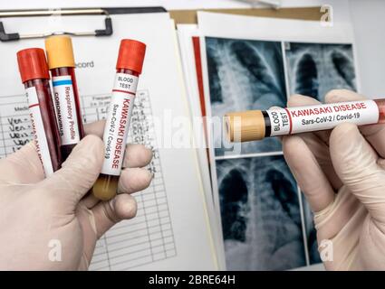 L'infermiere contiene campioni di sangue per il trattamento della malattia di Kawasaki correlata a Sars-COV-2 in bambini sotto i cinque anni, immagine concettuale, contenitori di farmaci generici senza marchio e. Foto Stock