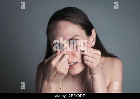 Acne pimple pelle macchia macchia pelle ragazza cura della pelle. Giovane donna dispiaciuta scopre un grande pimple sul viso, stringendolo. Foto Stock