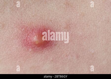 Pimple su infezione della pelle pimple a schioccare Foto Stock