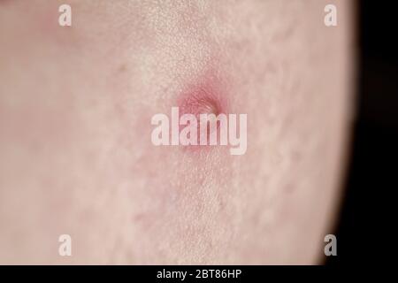 Pimple su infezione della pelle pimple a schioccare Foto Stock