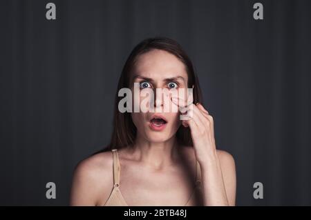 Ritratto di una femmina con un problema pimple sul viso. Foto Stock