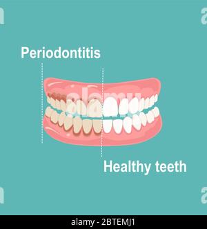 Vettore di denti e gengive umane, sani e affetti da periodontite Illustrazione Vettoriale