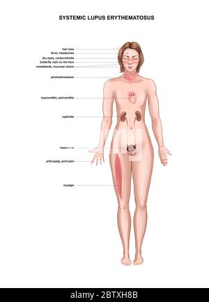 Illustrazione medica dei sintomi del lupus eritematoso sistemico Foto Stock