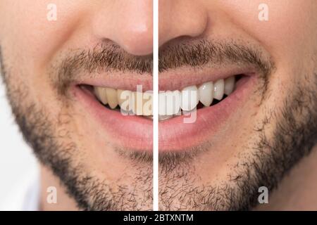 Denti prima e dopo l'imbiancamento. Concetto di cura dentale Foto Stock