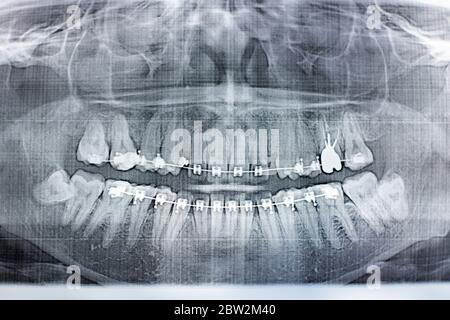 Fotografia a raggi X dei denti umani con un sistema di bretelle. Dente di saggezza ritardato Foto Stock