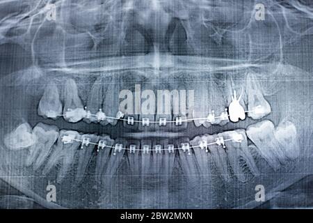 Fotografia a raggi X dei denti umani con un sistema di bretelle. Dente di saggezza ritardato Foto Stock