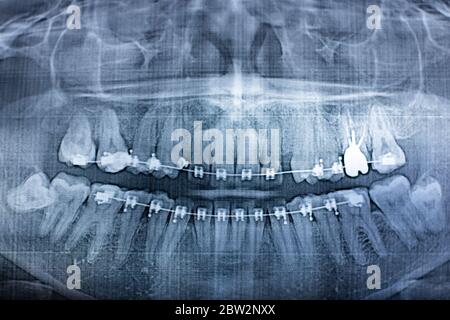 Fotografia a raggi X dei denti umani con un sistema di bretelle. Dente di saggezza ritardato Foto Stock