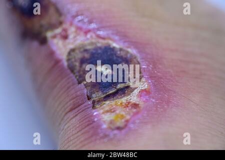 Closeup di bolle scab sul piede uomo. Foto Stock