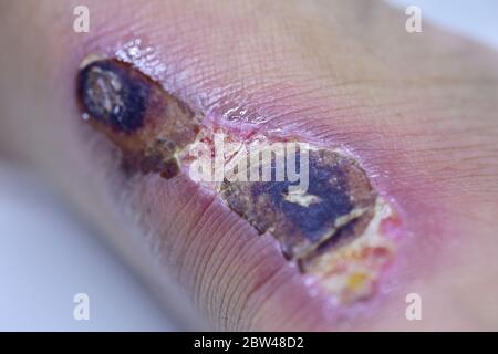 Closeup di bolle scab sul piede uomo. Foto Stock