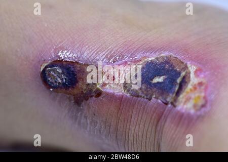 Closeup di bolle scab sul piede uomo. Foto Stock