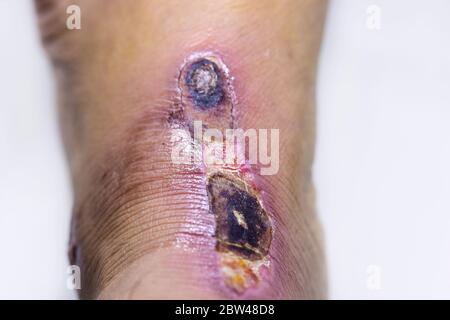 Closeup di bolle scab sul piede uomo. Foto Stock