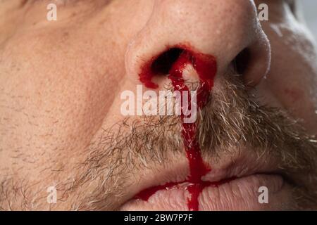 Sanguinamenti di naso , UN uomo sta sanguinando dal naso Foto Stock