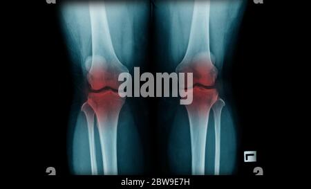 L'immagine radiografica mostra il ginocchio OA su entrambi i lati su sfondo scuro Foto Stock