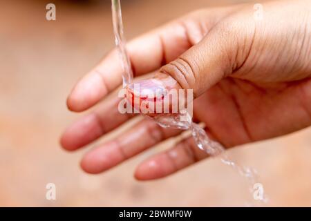 La soluzione salina viene versata sul dito umano con unghie nere, contorte con sangue. Foto Stock