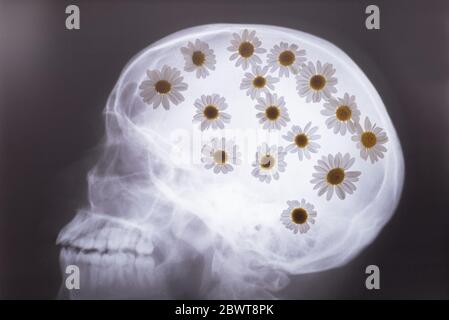 Un'immagine a raggi X con roentgenogramma del profilo cranio-scull raggi X delle ossa del cranio, con margherite bianche riempite nell'immagine. Medico Foto Stock