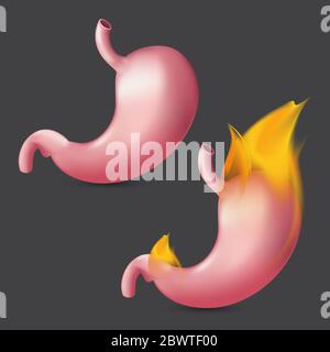 Stomaco bruciante. Organo umano realistico di sistema di digestione interna su fuoco. Illustrazione vettoriale di bruciore di stomaco digestivo, dolore gastrico o esofago Illustrazione Vettoriale